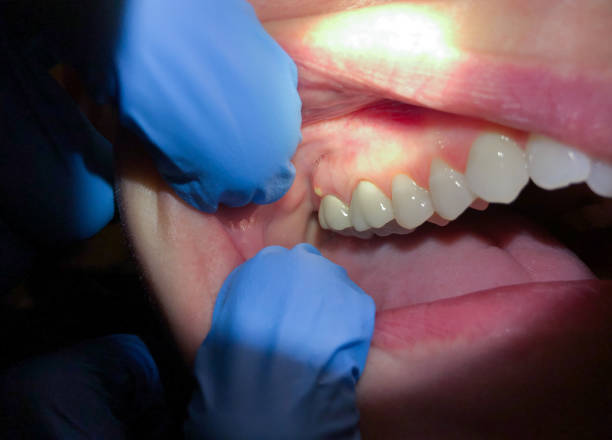 Best Emergency Dental Extractions in State College, PA